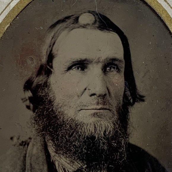 1880’s Skull Base Tumor On Mans Head Medical Daguerreotype photograph Golf Ball! - Picture 2 of 4